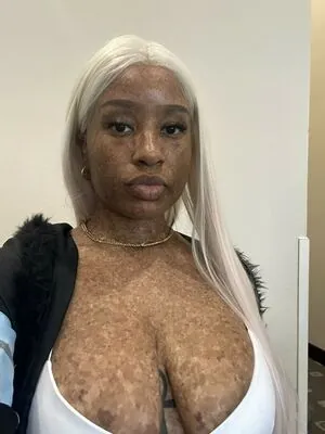 freckledn