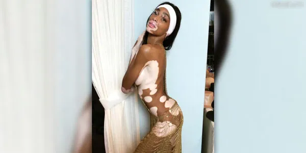 Winnie Harlow